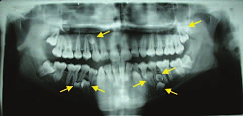 علل رشد دندان های اضافه