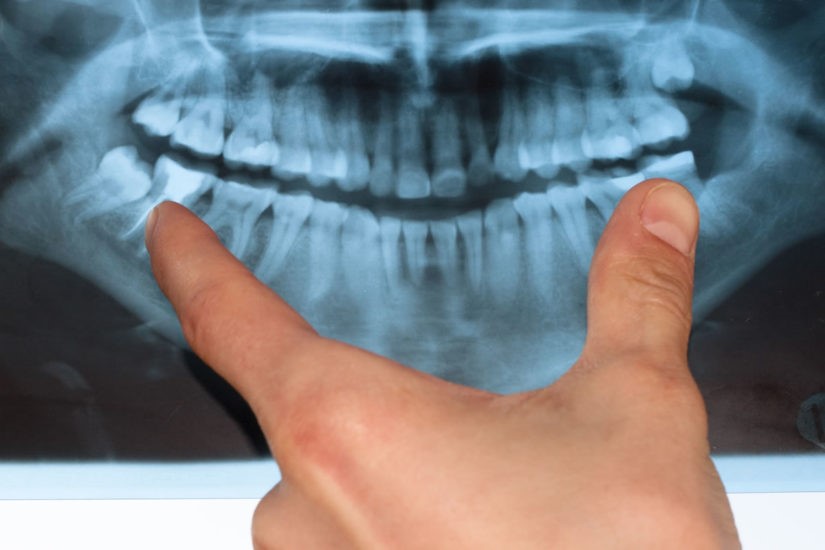 دندان عقل و درمان ارتودنسی