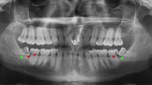 دندان عقل و درمان ارتودنسی