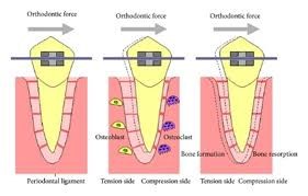ارتودنسی و تحلیل ریشه دندان