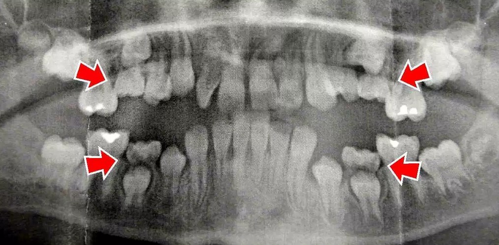 دندان فک جوش (انکیلوز دندان)