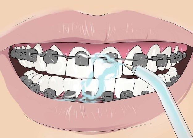 نحوه استفاده از نخ دندان در ارتودنسی