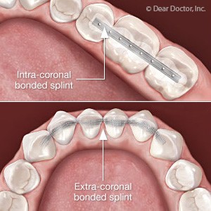 ارتودنسی و دندان های لق