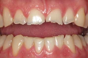 عادات بد دهانی منجر به مال اکلوژن