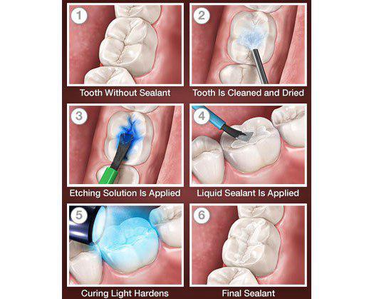 جلوگیری از پوسیدگی دندان در طول درمان ارتودنسی