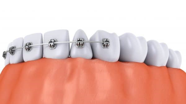 آسیب ارتودنسی به درمان دندانپزشکی