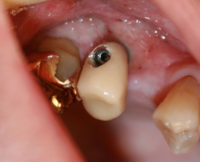 مزایا و معایب ایمپلنت دندانی
