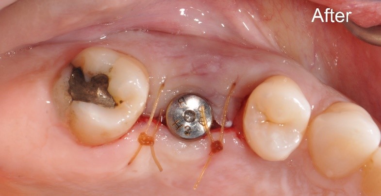 مراقبت پس از کاشت ایمپلنت دندانی