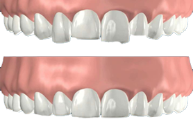 کانتور یا تغییر شکل دندان با تراش دندان