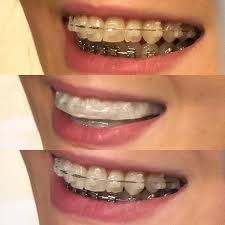  سفید نگه داشتن دندان در طول ارتودنسی