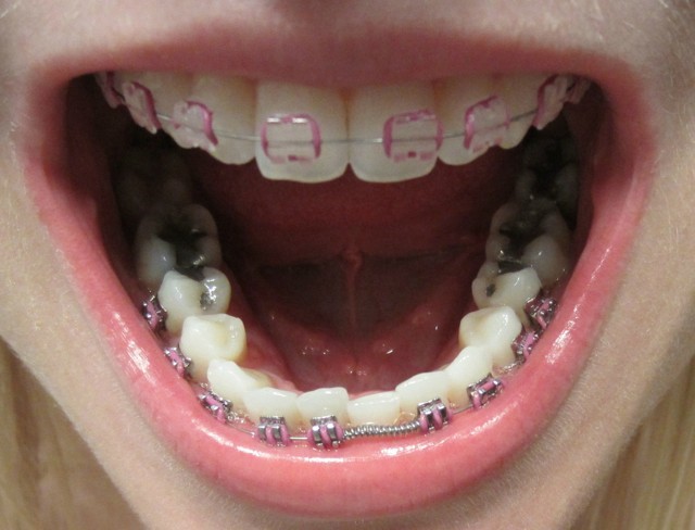 ارتودنسی دندان عصبکشی شده