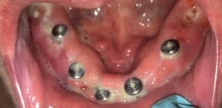 عفونت ایمپلنت دندانی