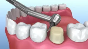 مشکلات روکشهای دندان