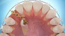 ارتودنسی دندانهای نهفته