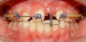 ارتودنسی دندانهای نهفته