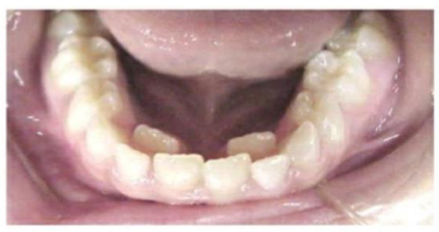  سریال اکسترکشن دندان