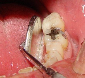 خارج شدن پر شدگی دندان 