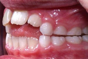اپن بایت یا فاصله بین دندانهای جلویی بالا و پایین