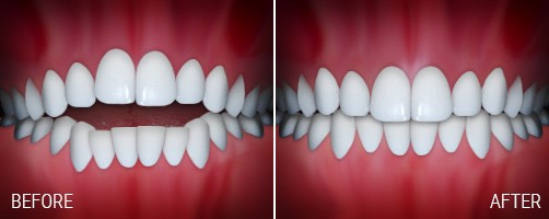 اپن بایت یا فاصله بین دندانهای جلویی بالا و پایین
