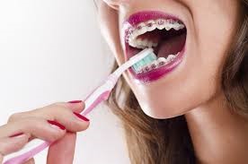 رعایت بهداشت دهان و دندان در طی درمان ارتودنسی