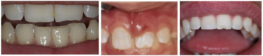 عادت جویدن ناخن و اثر آن روی دندان