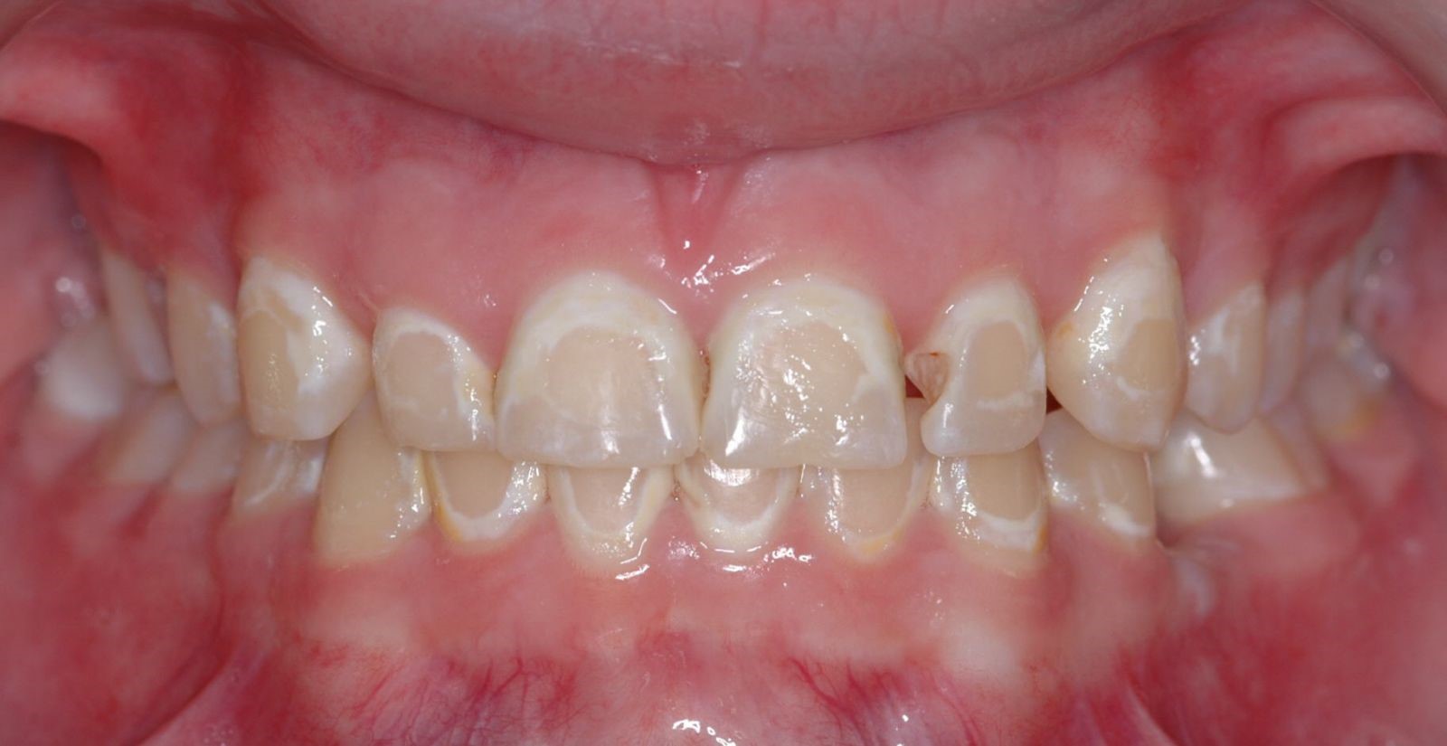 خشکی دهان در طول درمان ارتودنسی