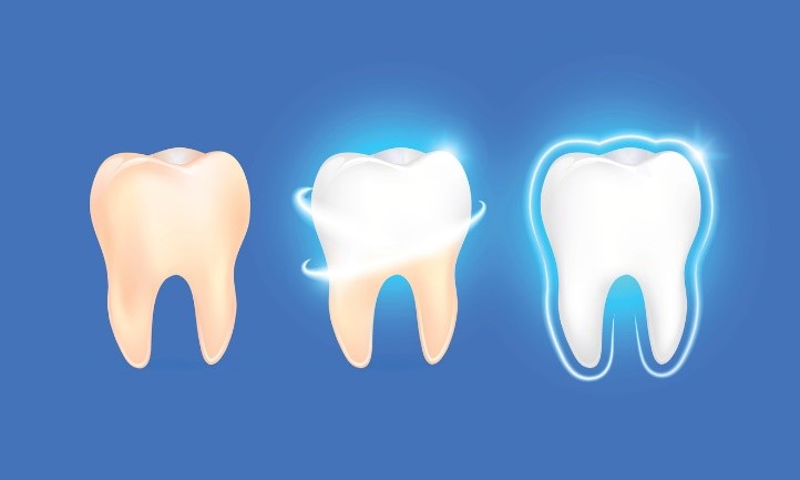 تقویت مینای دندان طی درمان ارتودنسی