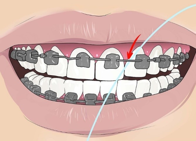 نحوه استفاده از نخ دندان در ارتودنسی