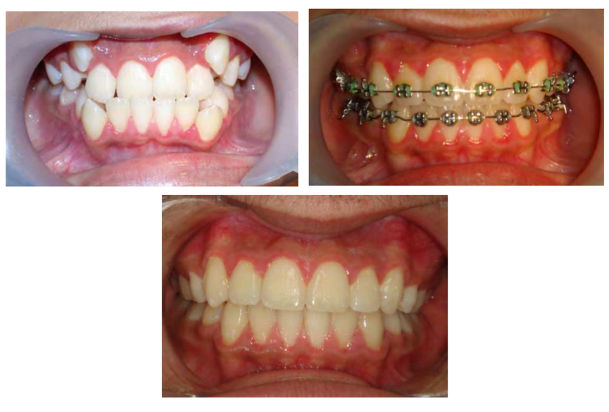 پوسیدگی دندان و درمان ارتودنسی - بخش دوم 