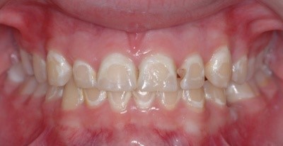 پوسیدگی دندان و درمان ارتودنسی