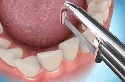 تراش دندان برای درمان ارتودنسی