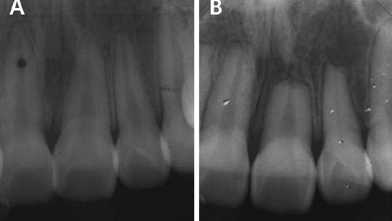 تحلیل ریشه دندان در طول درمان ارتودنسی