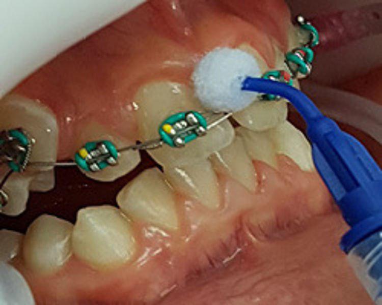 جلوگیری از پوسیدگی دندان در طول درمان ارتودنسی