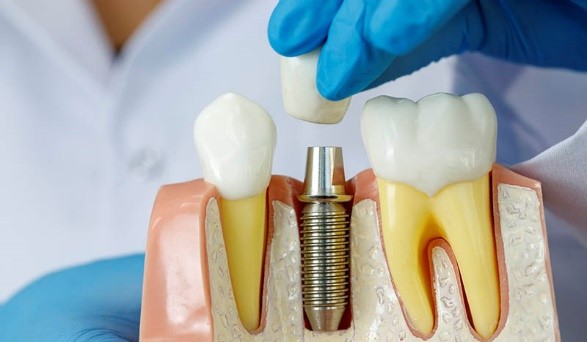 آسیب ارتودنسی به درمان دندانپزشکی