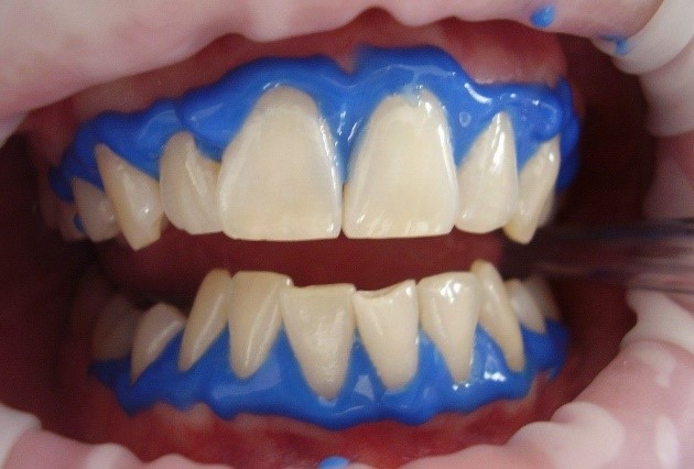 سفید کردن یا بلیچینگ دندان