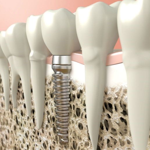 مزایا و معایب ایمپلنت دندانی