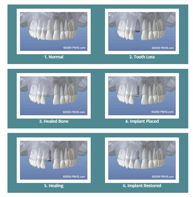 کاشت ایمپلنت های دندانی