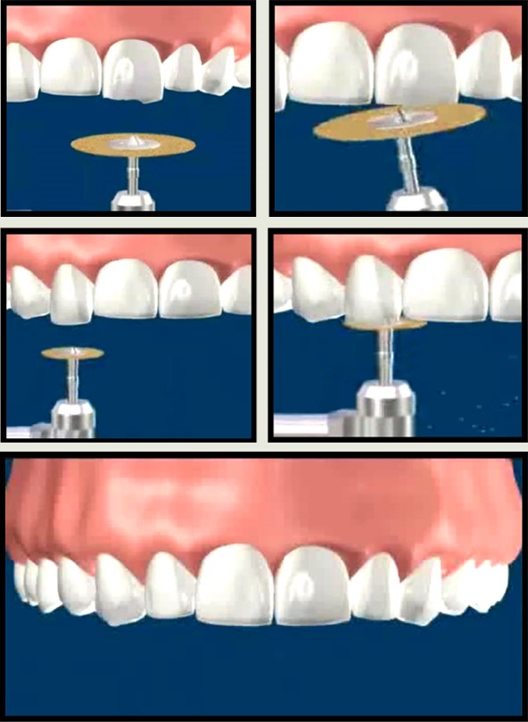 کانتور یا تغییر شکل دندان با تراش دندان