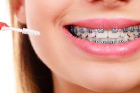 سفید نگه داشتن دندان در طول ارتودنسی
