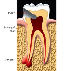 درمان ریشه یا عصب کشی دندان