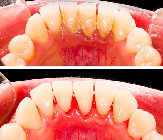 جرمگیری و تسطیح سطح ریشه دندان