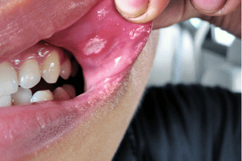 آفت دهان درمان آفت