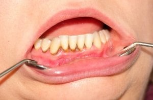 پلاک دندان