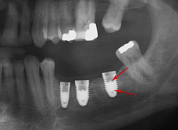  عفونت ایمپلنت دندانی