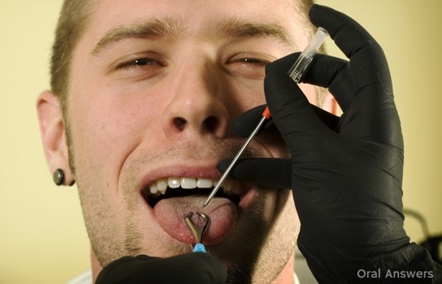 خطرات پیرسینگ دهانی برای دندان