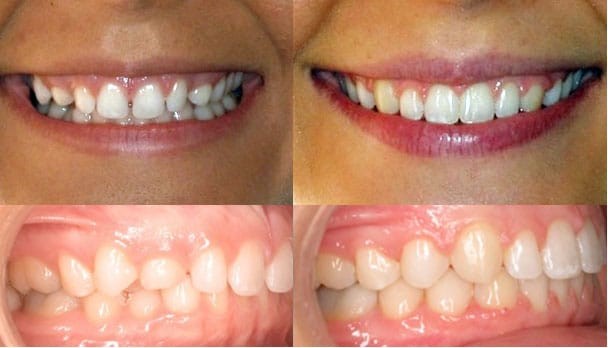 انحراف رو به جلوی دندان بعد از ارتودنسی