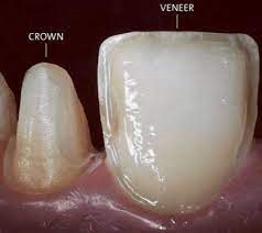 مقایسه روکش دندان و ونیر یا لمینت
