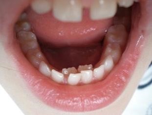 دندان شیری در بزرگسالان