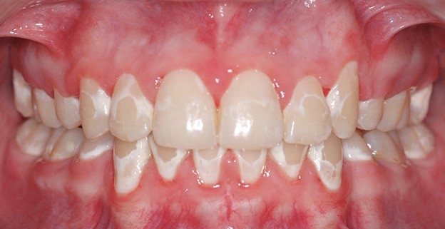سفید شدن دندان در ارتودنسی