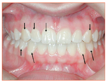 سفید شدن دندان در ارتودنسی